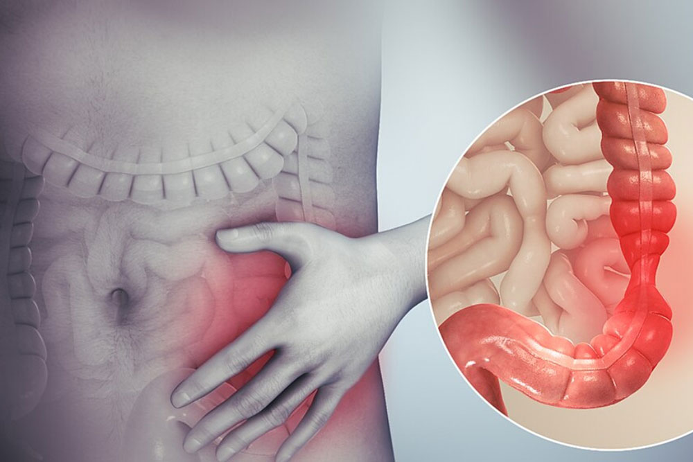 Τι είναι το Σύνδρομο Ευερέθιστου Εντέρου (ΣΕΕ);